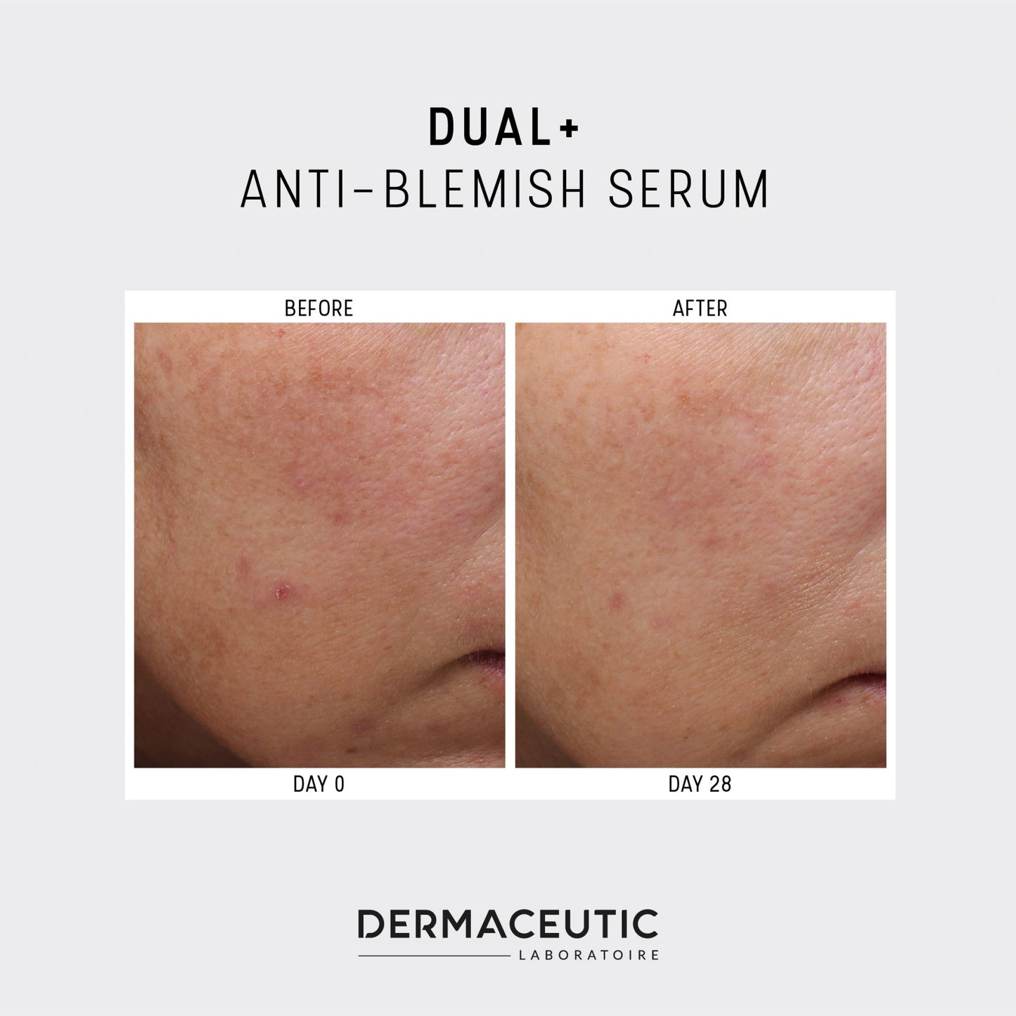 Dermaceutic Dual+ Anti Blemish Serum 30ml